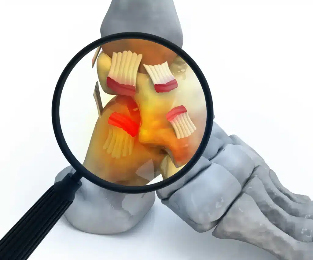 踝关节韧带手术