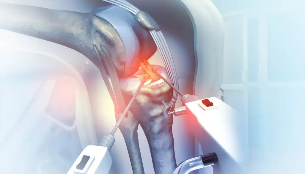 Illustration of a partial knee replacement surgery.