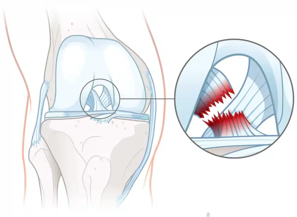 A knee ligament injury.